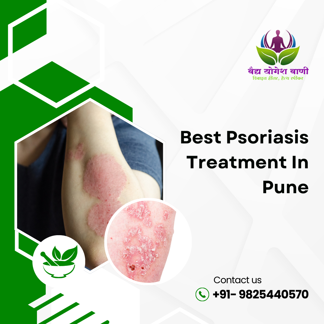 Why Vaidya Yogesh Vani Offers the Best Psoriasis Treatment in Pune 1 Why Vaidya Yogesh Vani Offers the Best Psoriasis Treatment in Pune